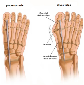 piede normale vs alluce valgo